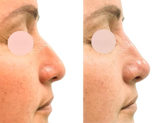 Liquid Rhinoplasty Before and After Photos in Miami, FL, Patient 19149