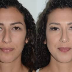Rhinoplasty Before and After Photos in Miami, FL, Patient 19463