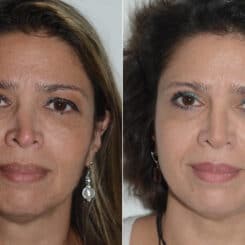 Revision Rhinoplasty Before and After Photos in Miami, FL, Patient 19477