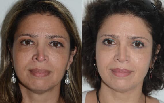 Revision Rhinoplasty Before and After Photos in Miami, FL, Patient 19477