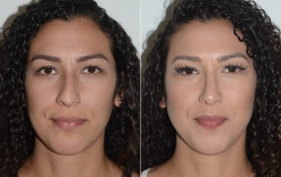 Rhinoplasty Before and After Photos in Miami, FL, Patient 19463