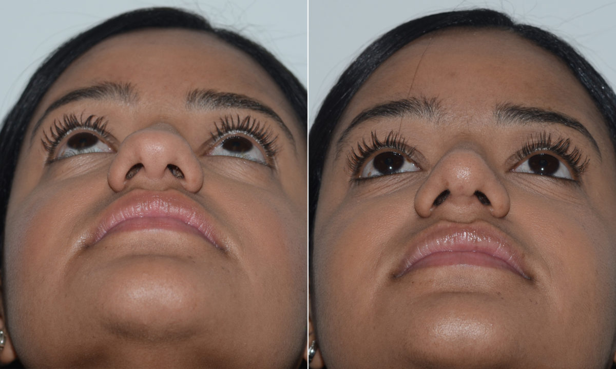 Rhinoplasty Before and After Photos in Miami, FL, Patient 19588