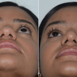 Rhinoplasty Before and After Photos in Miami, FL, Patient 19588