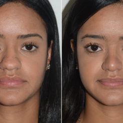 Rhinoplasty Before and After Photos in Miami, FL, Patient 19588