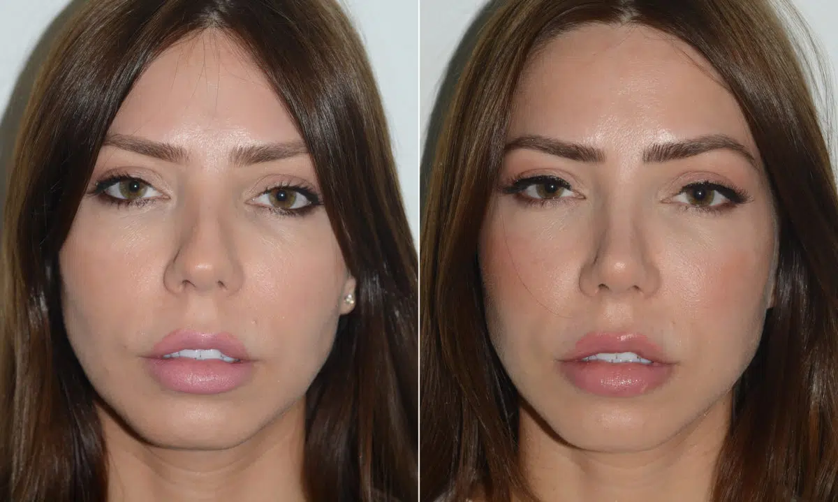 Rhinoplasty Before and After Photos in Miami, FL, Patient 19609