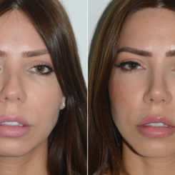 Rhinoplasty Before and After Photos in Miami, FL, Patient 19609