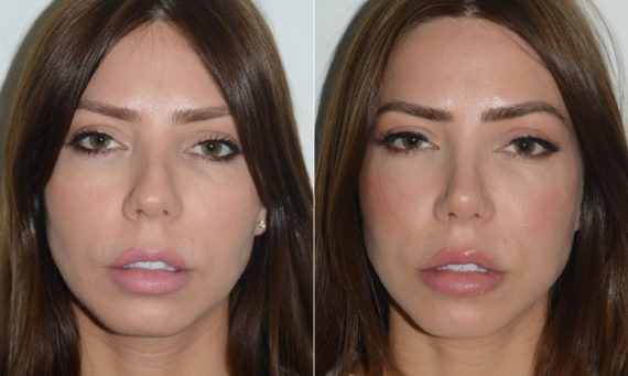 Rhinoplasty Before and After Photos in Miami, FL