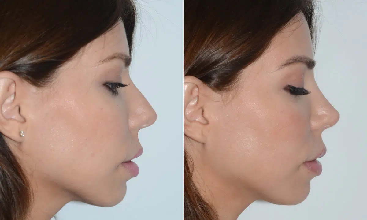 Rhinoplasty Before and After Photos in Miami, FL, Patient 19609