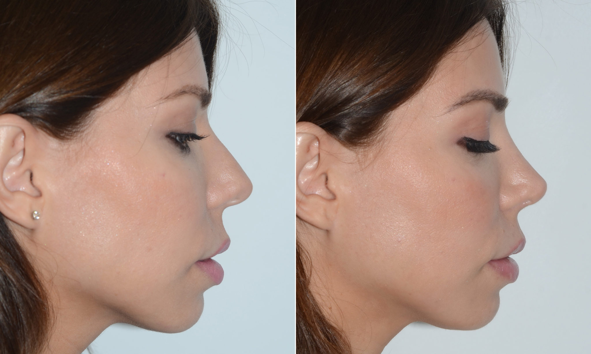 Rhinoplasty photos Miami, FL. Patient 19609