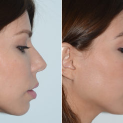 Rhinoplasty Before and After Photos in Miami, FL, Patient 19609