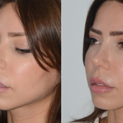 Rhinoplasty Before and After Photos in Miami, FL, Patient 19609