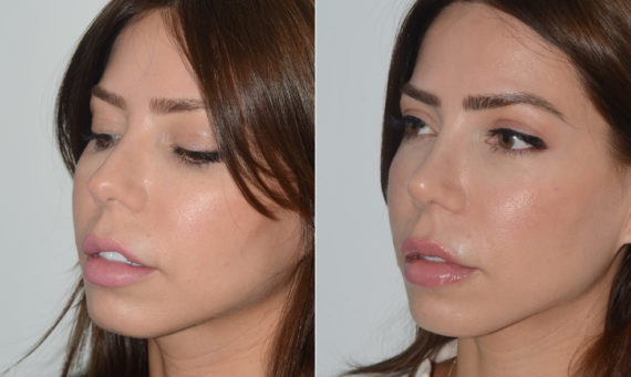 Rhinoplasty Before and After Photos in Miami, FL, Patient 19609