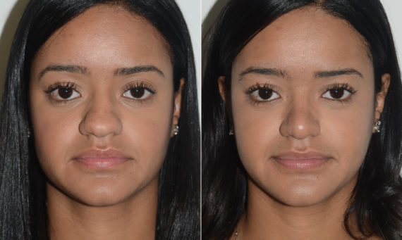 Rhinoplasty Before and After Photos in Miami, FL, Patient 19588