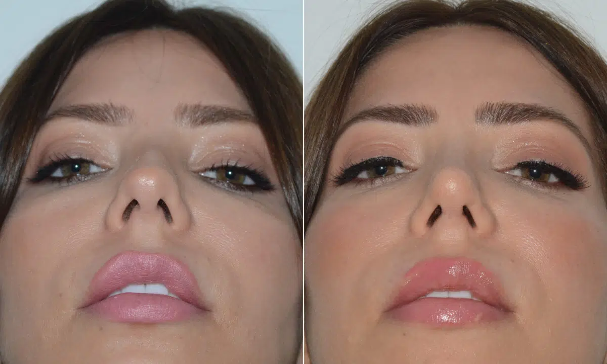 Rhinoplasty Before and After Photos in Miami, FL, Patient 19609