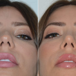 Rhinoplasty Before and After Photos in Miami, FL, Patient 19609