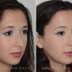 Rhinoplasty Before and After Photos in Miami, FL, Patient 17846
