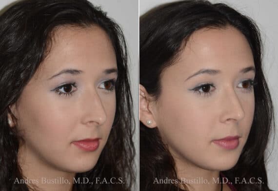 Rhinoplasty Before and After Photos in Miami, FL, Patient 17846