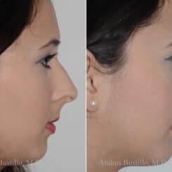 Rhinoplasty Before and After Photos in Miami, FL, Patient 17846