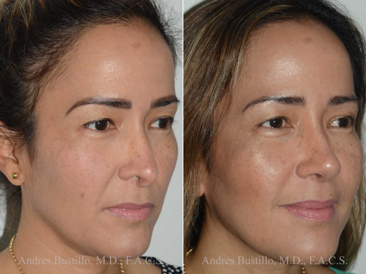 Revision Rhinoplasty Before and After Photos in Miami, FL, Patient 17864