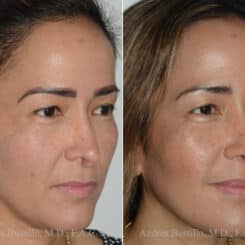 Revision Rhinoplasty Before and After Photos in Miami, FL, Patient 17864