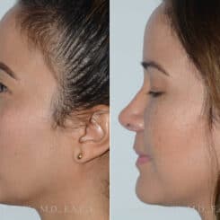 Revision Rhinoplasty Before and After Photos in Miami, FL, Patient 17864
