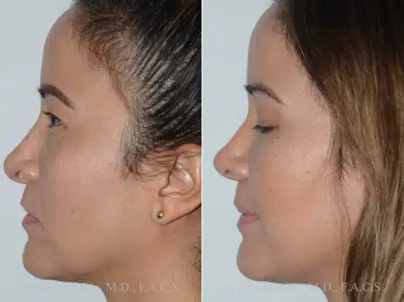 Revision Rhinoplasty Before and After Photos in Miami, FL, Patient 17864