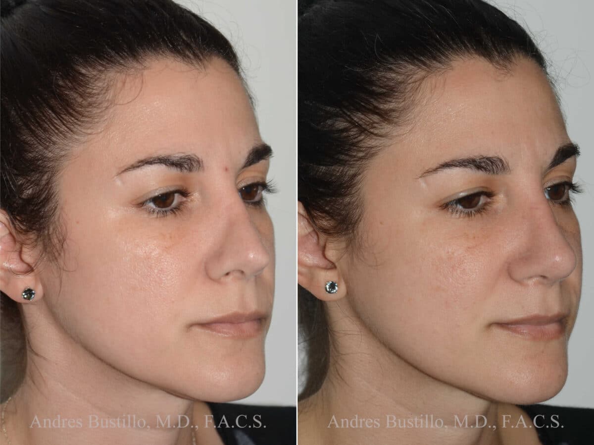 Revision Rhinoplasty Before and After Photos in Miami, FL, Patient 17873