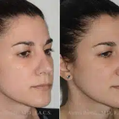 Revision Rhinoplasty Before and After Photos in Miami, FL, Patient 17873