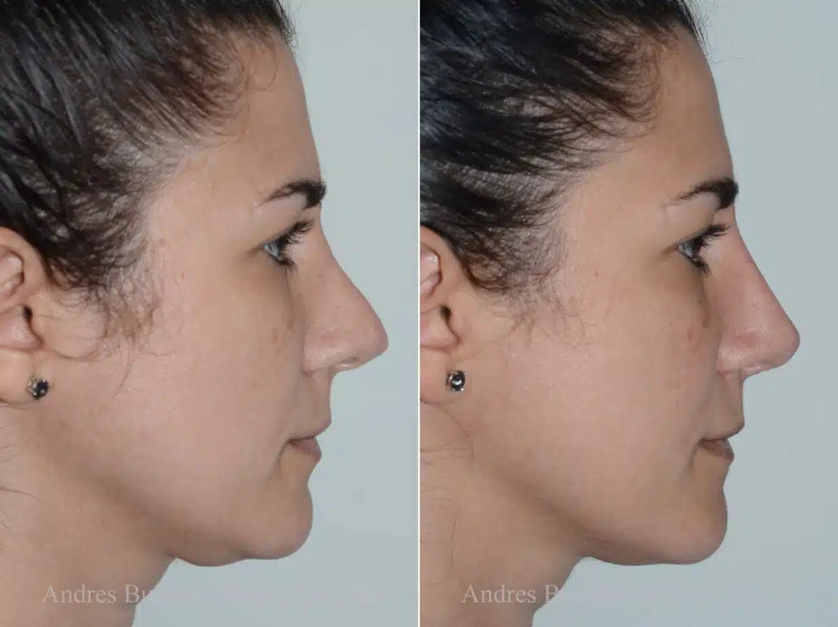 Revision Rhinoplasty Before and After Photos in Miami, FL, Patient 17873