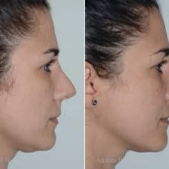 Revision Rhinoplasty Before and After Photos in Miami, FL, Patient 17873