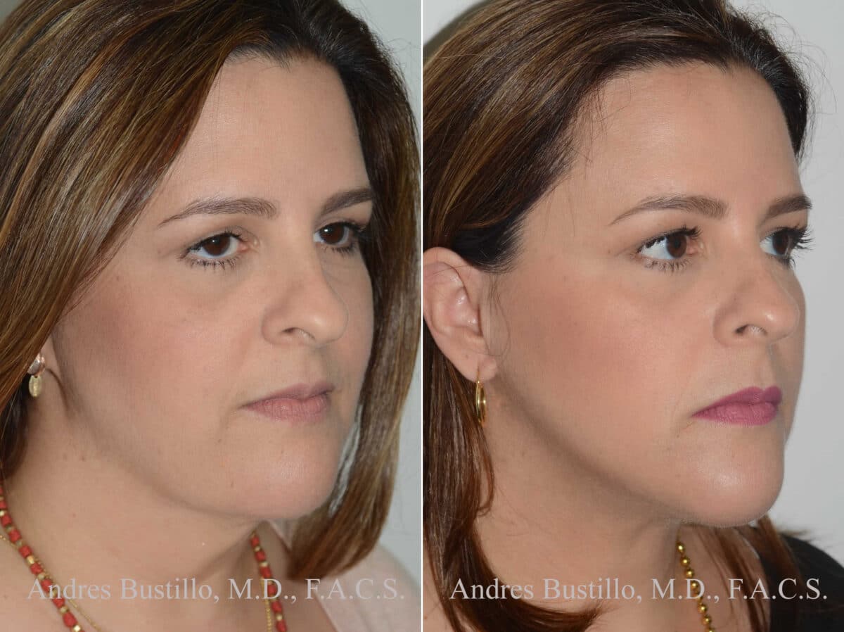 Deep Plane Facelift Before and After Photos in Miami, FL, Patient 17891