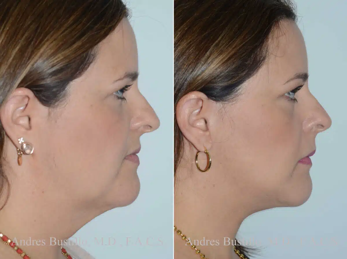 Deep Plane Facelift Before and After Photos in Miami, FL, Patient 17891