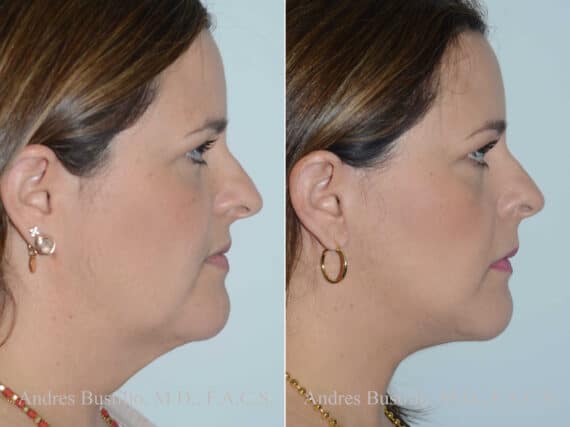 Deep Plane Facelift Before and After Photos in Miami, FL, Patient 17891