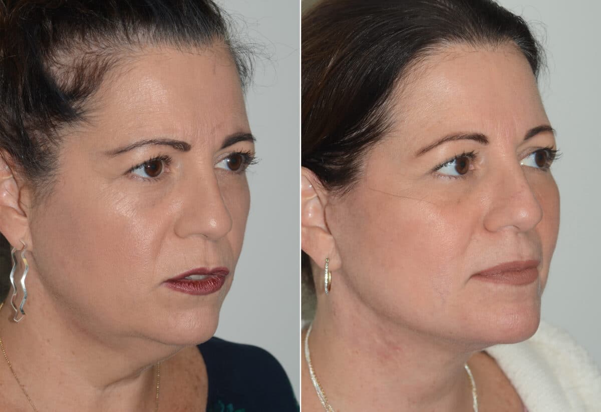 Deep Plane Facelift Before and After Photos in Miami, FL, Patient 19103