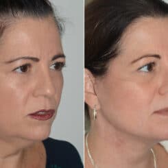 Deep Plane Facelift Before and After Photos in Miami, FL, Patient 19103