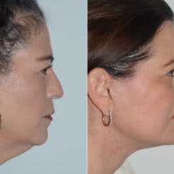 Deep Plane Facelift Before and After Photos in Miami, FL, Patient 19103
