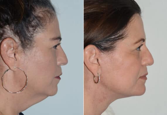 Deep Plane Facelift Before and After Photos in Miami, FL, Patient 19103