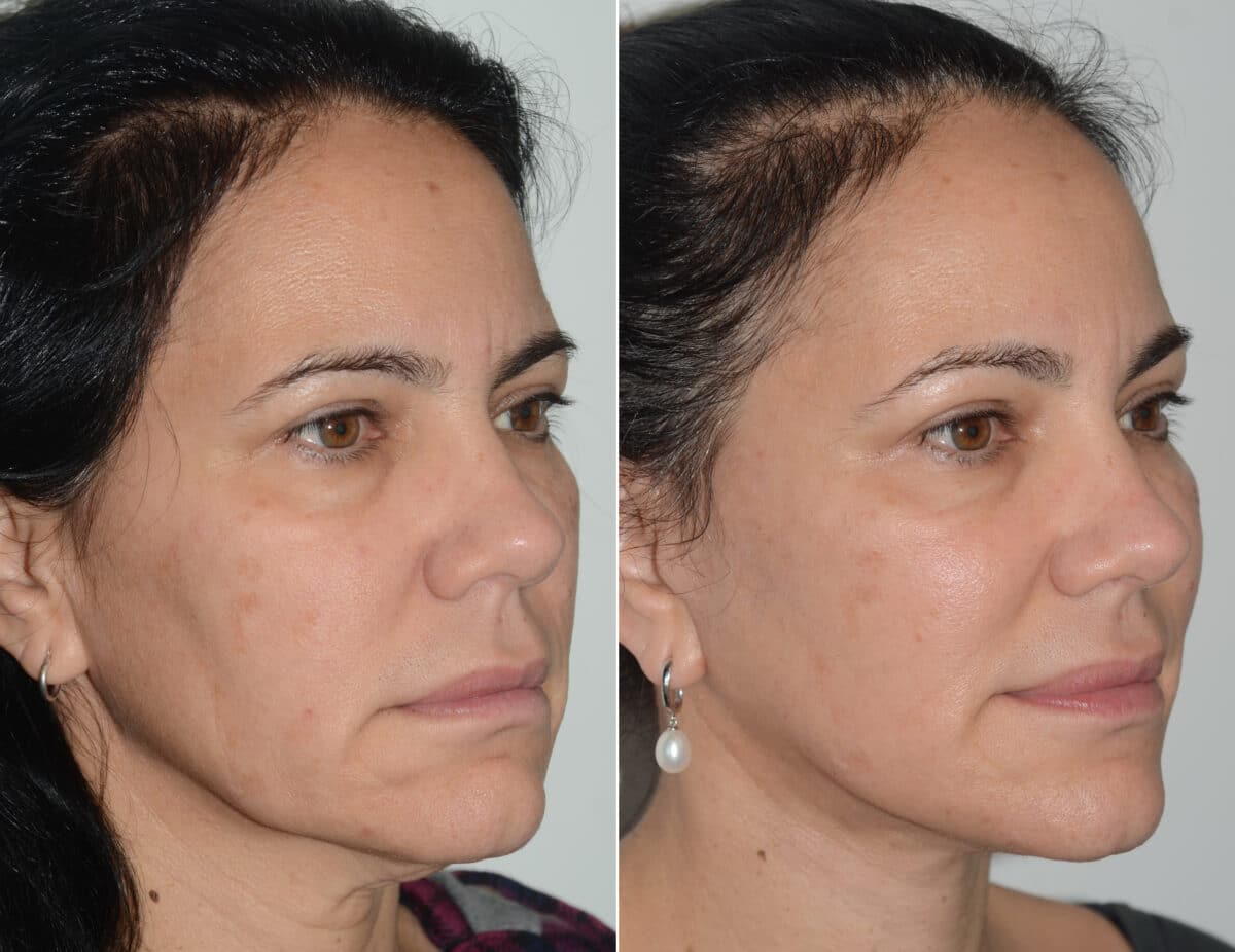 Deep Plane Facelift Before and After Photos in Miami, FL, Patient 19114