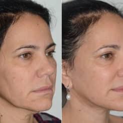 Deep Plane Facelift Before and After Photos in Miami, FL, Patient 19114
