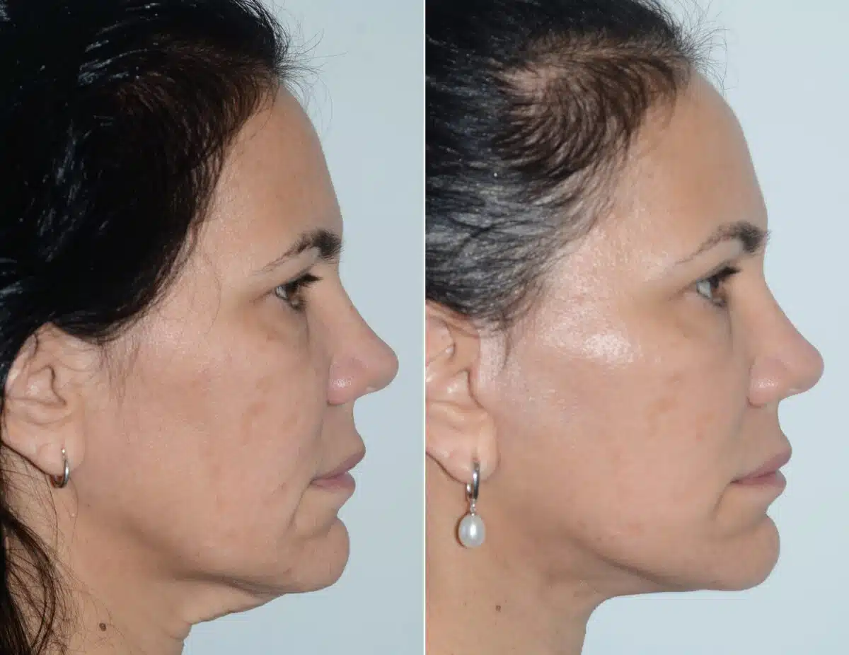 Deep Plane Facelift Before and After Photos in Miami, FL, Patient 19114