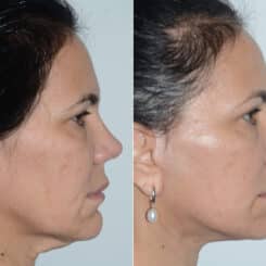 Deep Plane Facelift Before and After Photos in Miami, FL, Patient 19114