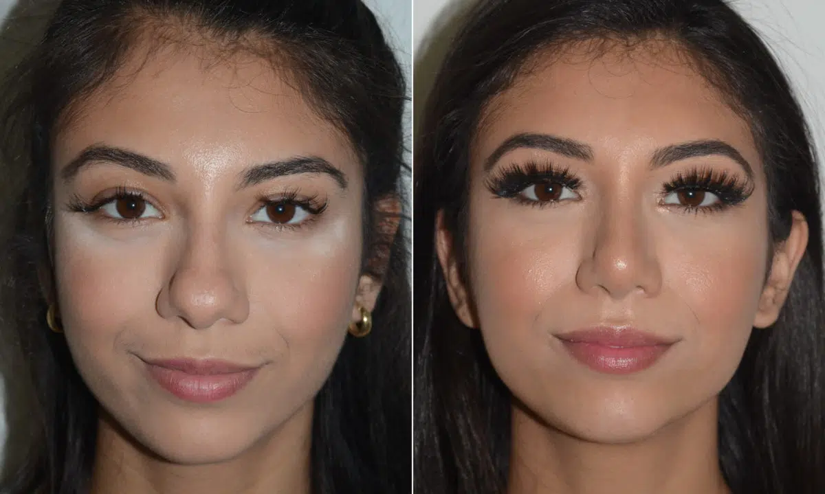 Rhinoplasty Before and After Photos in Miami, FL, Patient 19138