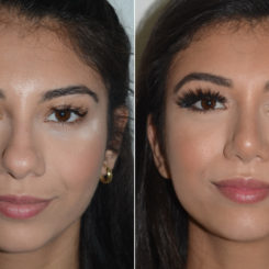 Rhinoplasty Before and After Photos in Miami, FL, Patient 19138