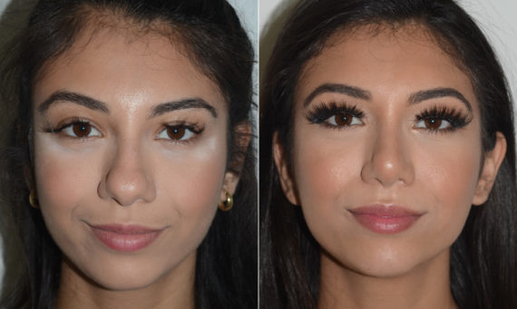 Rhinoplasty Before and After Photos in Miami, FL