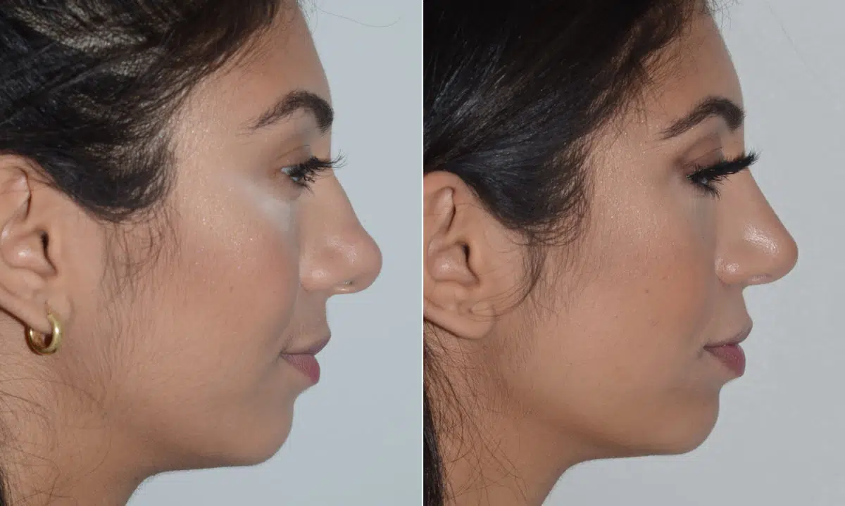 Rhinoplasty Before and After Photos in Miami, FL, Patient 19138