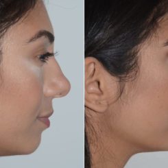 Rhinoplasty Before and After Photos in Miami, FL, Patient 19138