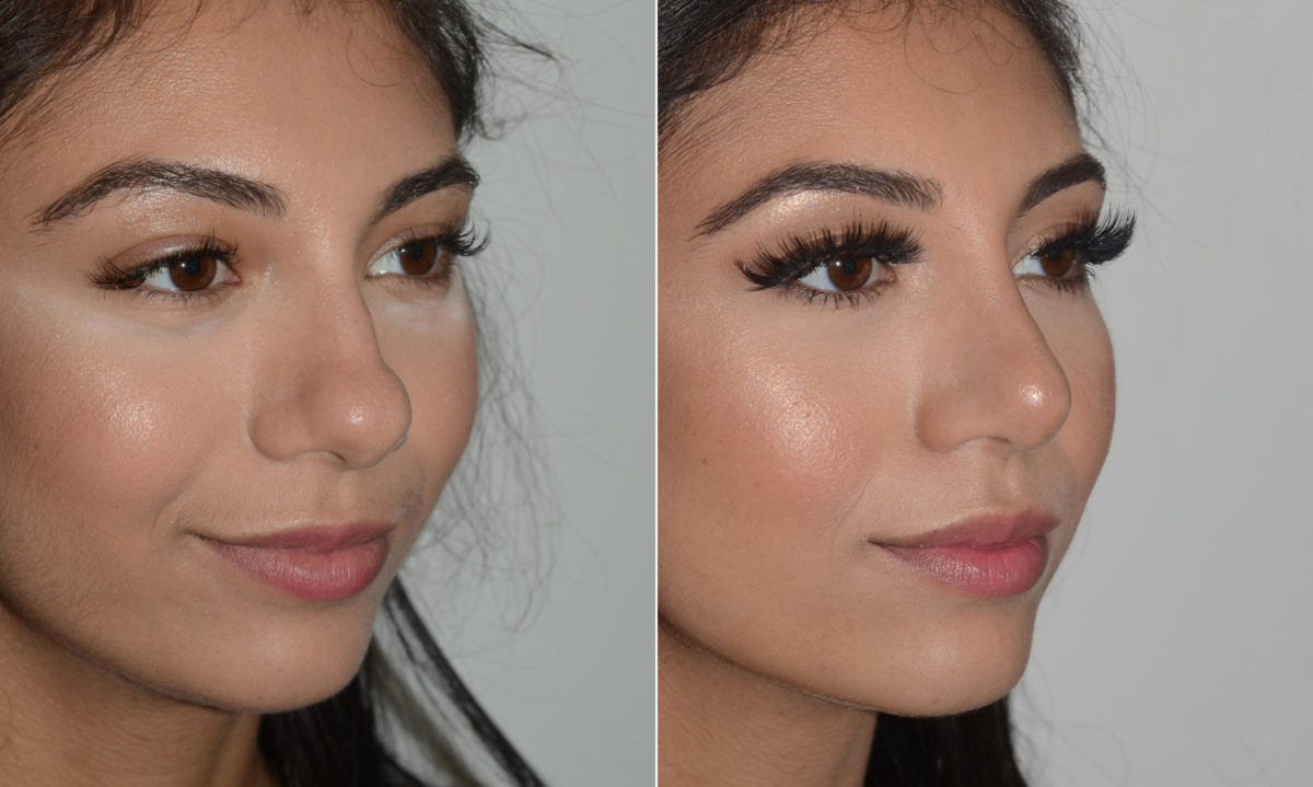 Rhinoplasty Before and After Photos in Miami, FL, Patient 19138