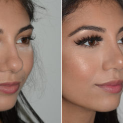 Rhinoplasty Before and After Photos in Miami, FL, Patient 19138