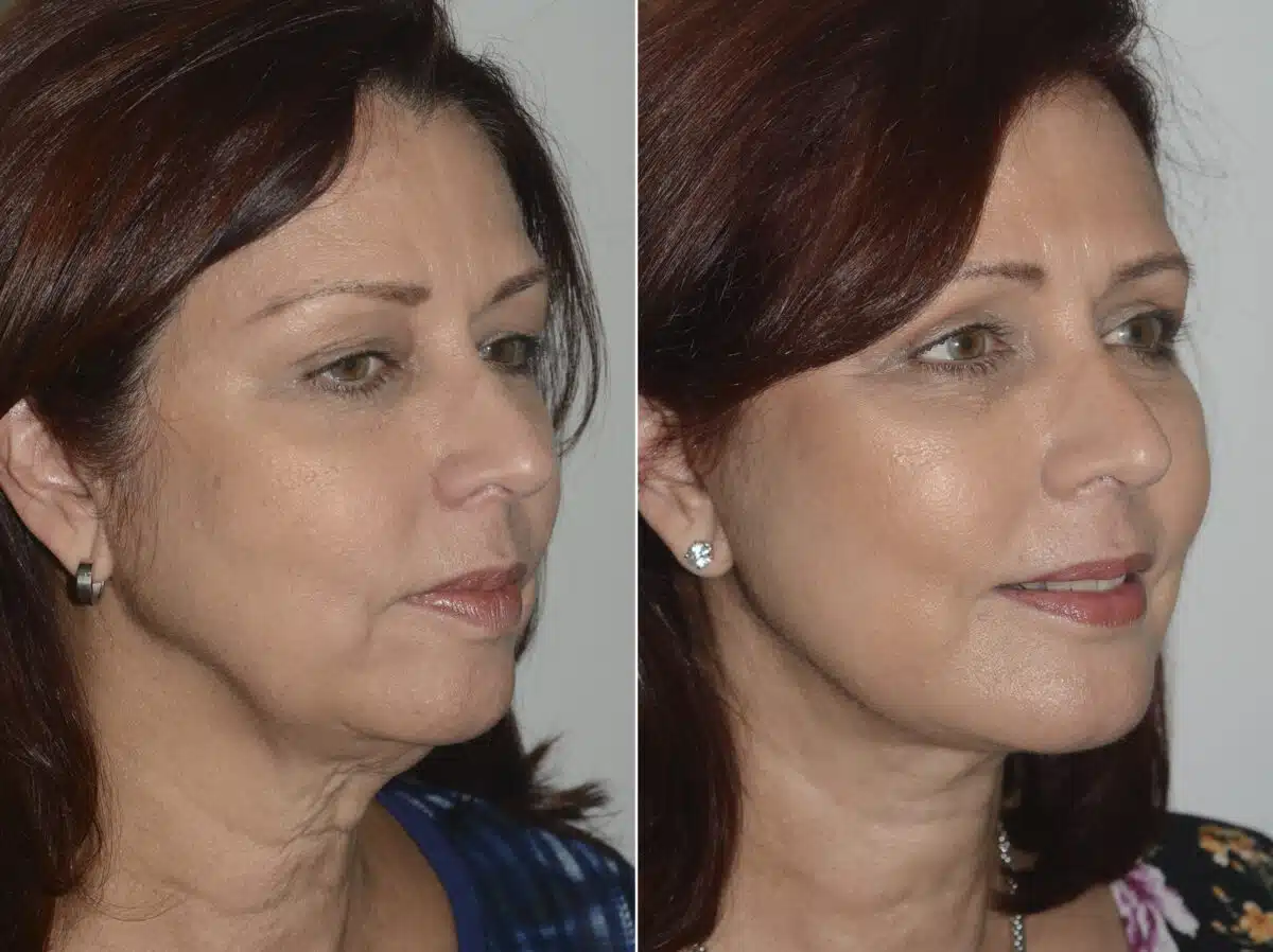 Deep Plane Facelift Before and After Photos in Miami, FL, Patient 19158