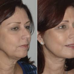 Deep Plane Facelift Before and After Photos in Miami, FL, Patient 19158